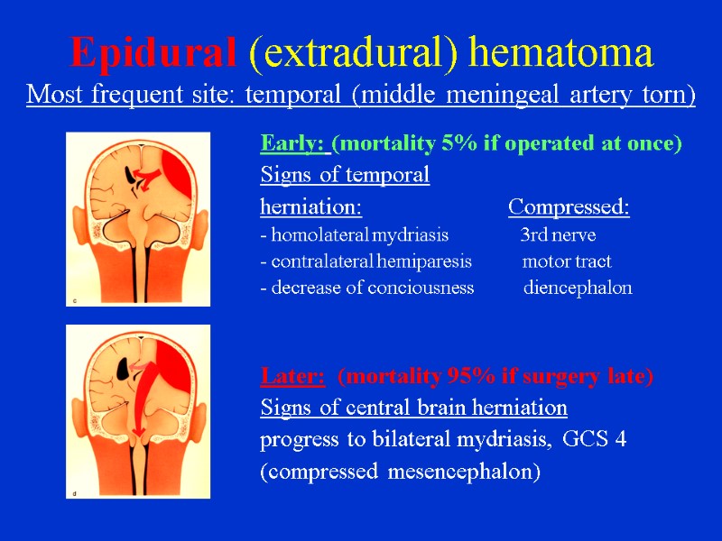 Epidural (extradural) hematoma Most frequent site: temporal (middle meningeal artery torn)  Early: (mortality